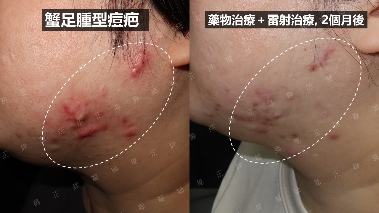 蟹足腫痘疤治療