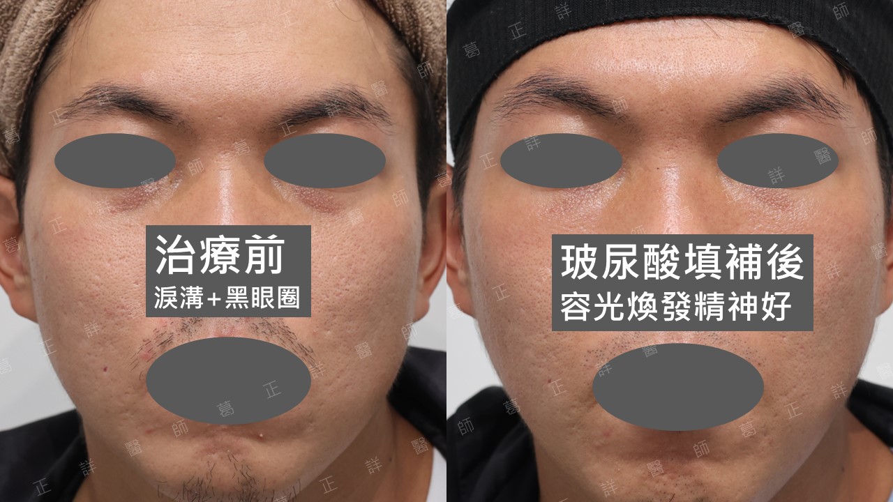 男生的淚溝黑眼圈使用玻尿酸填補改善